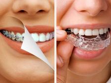 ದಾಳಿಂಬೆಯಂಥ ಹಲ್ಲುಗಳಿಗೆ ಅಲೈನರ್‌  ಅಥವಾ ಬ್ರೇಸರ್ ಯಾವುದು ಬೆಸ್ಟ್‌ ಆಯ್ಕೆ?