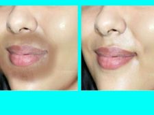 ಬಾಯಿಯ ಸುತ್ತಲು ಚರ್ಮ ಕಪ್ಪಗಾಗಿದ್ಯಾ? ನಾವು ಮಾಡುವ ತಪ್ಪುಗಳೇ ಇದಕ್ಕೆ ಕಾರಣ