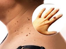 ಈ ಮನೆಮದ್ದುಗಳಿಂದ ನರಹುಲಿ(ಕೆಡು) ಸಮಸ್ಯೆಗೆ ಹೇಳಿ ಬೈಬೈ!