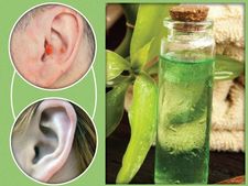 ಕಿವಿಯೊಳಗಡೆ ಮೊಡವೆ ಇದೆಯೇ? ಈ ಮನೆಮದ್ದು ಮಾಡಿದರೆ ಬೇಗನೆ ಒಣಗುವುದು