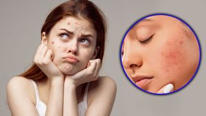 ಹಣೆ ಮತ್ತು ಕೆನ್ನೆಯಲ್ಲಿ ಮೊಡವೆಯೇ? ಹೊಟ್ಟೆ ಆರೋಗ್ಯ ಕಡೆ ಗಮನ  ನೀಡಿ