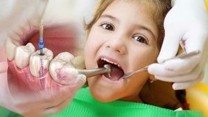 ಮಕ್ಕಳಿಗೆ ರೂಟ್‌ ಕೆನಲ್ ಮಾಡಿಸುವ ಅವಶ್ಯಕತೆ ಇದೆಯೇ?