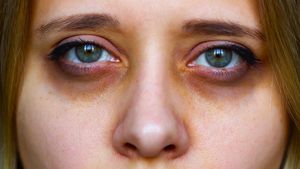 ಕಣ್ಣಿನ ಸುತ್ತಲಿನ ಕಪ್ಪು ಕಲೆಗಳಿಗೆ ಇಲ್ಲಿದೆ ಶಾಶ್ವತ ಪರಿಹಾರ..!