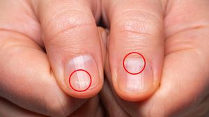 ದೇಹದಲ್ಲಿ ಈ ಬದಲಾವಣೆಗಳು ಕಂಡು ಬರ್ತಿದ್ಯಾ? ಹಾಗಾದ್ರೆ ಕ್ಯಾಲ್ಸಿಯಂ ಕೊರತೆಯಾಗಿದೆ ಎಂದರ್ಥ 