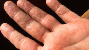 ಬೇಸಿಗೆಯಲ್ಲಿ ಬೆರಳುಗಳಲ್ಲಿ ಬೆವರು ಕಜ್ಜಿಗೆ ಪರಿಹಾರವೇನು?