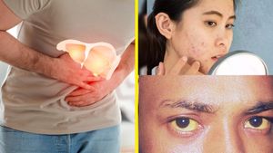 ಮುಖದಲ್ಲಿ, ತ್ವಚೆಯಲ್ಲಿ ಈ ರೀತಿ ಕಂಡು ಬಂದರೆ ಅದು ಫ್ಯಾಟಿ ಲಿವರ್‌ ಲಕ್ಷಣವಿರಬಹುದು!
