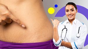 ಸ್ಟ್ರೆಚ್‌ಮಾರ್ಕ್ಸ್ ಹೋಗಲಾಡಿಸುವ 4 ಮೆಡಿಕಲ್ ವಿಧಾನಗಳಿವು