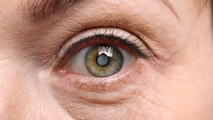 ಕಣ್ಣಿನ ಪೊರೆ ಬಂದರೆ  ನೈಸರ್ಗಿಕವಾಗಿ ಸಂಪೂರ್ಣ ಇಲ್ಲವಾಗಿಸಬಹುದೇ?