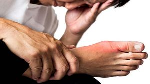 ಯೂರಿಕ್‌ ಆಮ್ಲ ಕಡಿಮೆ ಮಾಡಲು  ನೈಸರ್ಗಿಕವಾದ ಪರಿಹಾರಗಳೇನು?