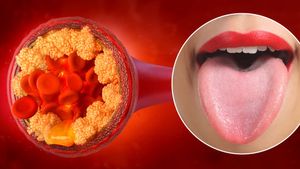 ಮಹಿಳೆಯರೇ, 30ರ ನಂತರ ಕೊಲೆಸ್ಟ್ರಾಲ್‌ ಹೆಚ್ಚಾದರೆ  ನಾಲಗೆಯಲ್ಲಿ ಕಂಡು ಬರುವ 7 ಲಕ್ಷಣಗಳಿವು