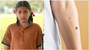 ಡರ್ಮಟೊಮಿಯೊಸಿಟಿಸ್ ಕಾಯಿಲೆಯಿಂದ ದಂಗಲ್ ನಟಿ ಸಾವು..! ಏನಿದು ಕಾಯಿಲೆ ಗೊತ್ತಾ?