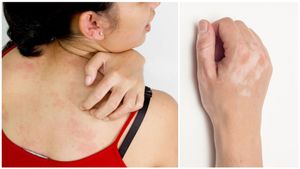 ಮೈ ಮೇಲೆ ಬಿಳಿ ಮಚ್ಚೆ ಮೂಡಿದರೆ ಹೀಗೆ ಮಾಡಿ..! ಮನೆಯಲ್ಲಿದೆ ಮದ್ದು..!