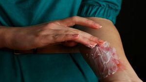 ಸುಟ್ಟ ಗಾಯಕ್ಕೆ ಟೂತ್‌ಪೇಸ್ಟ್ ಹಚ್ಚುತ್ತೀರಾ..? ಇಂದೇ ನಿಲ್ಲಿಸಿ ಬಿಡಿ..!