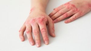 ಅಲಾಸ್ಕಾಪಾಕ್ಸ್‌ ತಗುಲಿದ್ದ ವ್ಯಕ್ತಿ ನಿಧನ..! ಏನಿದು ಹೊಸ ಸೋಂಕು ಗೊತ್ತಾ?