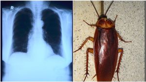 ಉಸಿರುಗಟ್ಟುತ್ತಿದೆ ಎಂದವನ ಶ್ವಾಸಕೋಶದಿಂದ ಜಿರಳೆ ಹೊರತೆಗೆದ ವೈದ್ಯರು..!!