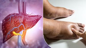 ದೇಹದಲ್ಲಿ ಈ 7 ಭಾಗದಲ್ಲಿ ಊತ ಉಂಟಾದರೆ ಅದು ಫ್ಯಾಟಿ ಲಿವರ್‌ನ ಲಕ್ಷಣವಾಗಿದೆ, ನಿರ್ಲಕ್ಷ್ಯ ಮಾಡಬೇಡಿ