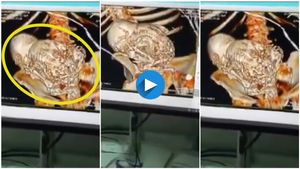 81 ವರ್ಷ ವೃದ್ಧೆ ಗರ್ಭದಲ್ಲಿ ಕಲ್ಲಿನ ಮಗು..! ವೈದ್ಯರಿಗೇ ಅಚ್ಚರಿ