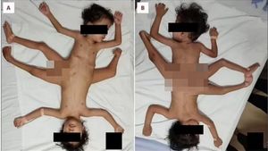 ಅಪರೂಪದಲ್ಲಿ ಅಪರೂಪ: ಮೂರು ಕಾಲಿನ ಅಂಟಿಕೊಂಡ ಅವಳಿಗಳ ಜನನ