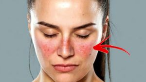  ಲುಪಸ್‌: ಮೈ ಮೇಲೆ  ರ‍್ಯಾಶ್ ನಿರ್ಲಕ್ಷ್ಯ ಬೇಡ್ವೆ ಬೇಡ, ಅಂಗಾಂಗ ವೈಫಲ್ಯವಾಗಿ ಜೀವಕ್ಕೆ ಅಪಾಯ ತರಬಹುದು