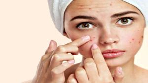 ಮೊಡವೆ-ಕಪ್ಪು ಕಲೆ ಒಂದೇ ವಾರಕ್ಕೆ ನಿವಾರಣೆ..! ಇಲ್ಲಿದೆ ಸಿಂಪಲ್ ಮನೆಮದ್ದು!