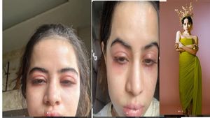 ಉರ್ಫಿ ಜಾವೇದ್‌ ಮುಖಕ್ಕೆ ಏನಾಗಿದೆ? ಆಕೆಯನ್ನು ಕಾಡುತ್ತಿರುವ ಸಮಸ್ಯೆ ಸೌಂದರ್ಯ ವೃದ್ಧಿ ಚಿಕಿತ್ಸೆಯಿಂದ ಬಂದಿದ್ದೇ?