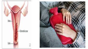 ಮಹಿಳೆಯರಿಗೆ ಕಾಡುವ ಎಂಡೊಮೆಟ್ರಿಯಲ್ ಕ್ಯಾನ್ಸರ್:  ಈ  ಕ್ಯಾನ್ಸರ್‌ಗೆ ಬಂದಿದೆ ಈ  ನವೀನ ಚಿಕಿತ್ಸಾ ವಿಧಾನಗಳು