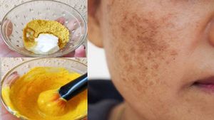 ಕೇವಲ 2 ಸಲ ಹಚ್ಚಿದ್ರೆ ಕಪ್ಪು ಕಲೆಗಳೇ ಇಲ್ಲವಾಗುತ್ತೆ..! ಹೇಗೆ ಗೊತ್ತಾ?