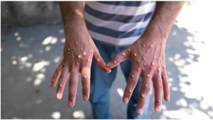 ಕೇರಳದಲ್ಲಿ ಮತ್ತೊಂದು ಶಂಕಿತ ಮಂಕಿಪಾಕ್ಸ್ ಪತ್ತೆ.! ಆರಂಭಿಕ ಲಕ್ಷಣವೇನು ಗೊತ್ತಾ?