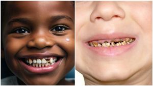 ಮಕ್ಕಳಲ್ಲಿ ಹಲ್ಲು ಹುಳುಕಿಗೆ ಪರಿಹಾರವೇನು? ಡೆಂಟೆಸ್ಟ್‌ ಹೇಳೋದೇನು ನೋಡಿ..!