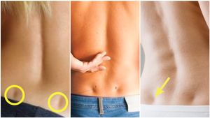 ಬೆನ್ನಿನ ಕೆಳಭಾಗದಲ್ಲಿ ಈ ಡಿಂಪಲ್ ಇದ್ದರೆ ಏನರ್ಥ..! ನಿಮಗೂ ಆಗಿದ್ಯಾ?