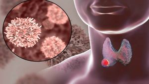 ಹರಡುವುದೇ ತಿಳಿಯುವುದಿಲ್ಲ ಈ ಥೈರಾಯ್ಡ್ ಕ್ಯಾನ್ಸರ್..! ಲಕ್ಷಣವೇನು ಗೊತ್ತಾ?