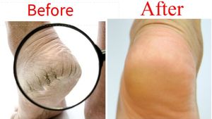 ಒಡೆದ ಹಿಮ್ಮಡಿಗಳಿಗೆ ನಿಮಿಷದಲ್ಲೇ ಪರಿಹಾರ.! ಮನೆಯಲ್ಲೇ ಈ ರೀತಿ ಮಾಡಿ ನೋಡಿ..!!