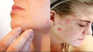 ಹಣೆ ಮೇಲಿನ ಮೊಡವೆ ಕ್ಯಾನ್ಸರ್ ಆಗಿ ಬದಲು..! ಆಘಾತಕ್ಕೊಳಗಾದ ಮಹಿಳೆ! 