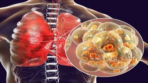 ಬೆಂಗಳೂರಲ್ಲಿ ಹರಡುತ್ತಿದೆ ನ್ಯುಮೋನಿಯಾ: ವೈರಸ್ ಹರಡೋಕೆ ಕಾರಣವೇನು?