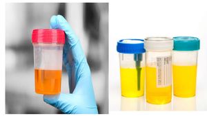 ನಿಮ್ಮ ಮೂತ್ರದ  ಬಣ್ಣ ಗಮನಿಸಿದ್ದೀರಾ? ಯಾವ ಬಣ್ಣ ಯಾವ ಕಾಯಿಲೆಯ ಸೂಚನೆ ಗೊತ್ತಾ?