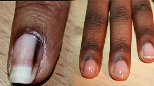 ಉಗುರಿನ ಮೇಲೆ ಕಪ್ಪು ಗೆರೆಗಳಿಂದ ತಿಳಿದಿತ್ತು ಕ್ಯಾನ್ಸರ್..! ಮೆಲನೋಮ್ ಗೆದ್ದ ಮಹಿಳೆ..!