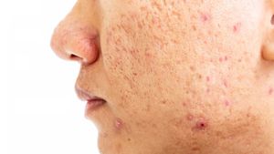 Beauty Tips: ಮುಖದ ಮೇಲಿನ ಚಿಕ್ಕ ರಂಧ್ರಗಳು ಮುಖ ಹಾಳು ಮಾಡಿದ್ಯಾ? ಇಲ್ಲಿವೆ ಸುಲಭದ ಪರಿಹಾರ