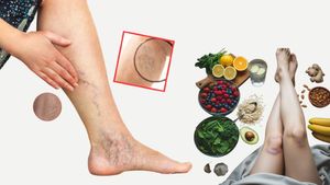 ವೆರಿಕೋಸ್ ವೇನ್‌ ಸಮಸ್ಯೆನಾ?: ನಿತ್ಯ ಈ 9 ಆಹಾರ ಸೇವಿಸಿ! ರಕ್ತನಾಳ ಬಲ, ನೋವು-ಊತ ಶಾಶ್ವತವಾಗಿ ಮಾಯ