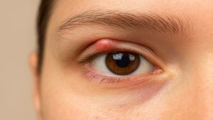 ಕಣ್ಣಿನ ಬಳಿ ಉಂಟಾಗುವ ಹುಣ್ಣು ನಿವಾರಣೆಗೆ ಇಲ್ಲಿದೆ ಮನೆಮದ್ದು!!