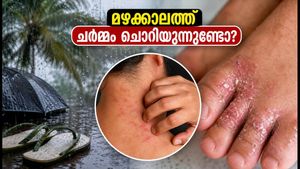 മഴക്കാലത്ത് ചർമ്മം ചൊറിയുന്നുണ്ടോ? ഫംഗൽ അണുബാധയും താരനും തടയാൻ ഈ മുൻകരുതലുകൾ എടുക്കൂ
