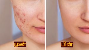 முகத்தில் உள்ள அசிங்கமான தழும்புகளை போக்க வேண்டுமா? இந்த வழிகளை ட்ரை பண்ணுங்க..