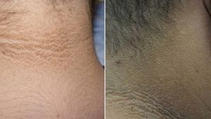 మెడ వెనుక నలుపు మురికి అనుకుంటున్నారా? పెద్ద అనారోగ్యానికి సంకేతం!