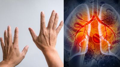  World Lung Cancer Day 2025: घर बैठे सिर्फ 5 सेकंड का टेस्ट बताएगा, फेफड़ों में कैंसर है या नहीं?