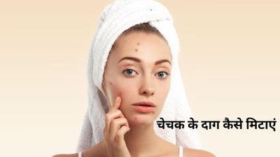चेहरे पर पड़े चेचक के दाग हटाने के 5 घरेलू उपाय, जिद्दी गड्ढों और माता के निशान से पाएं छुटकारा