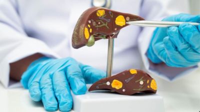 Tech, Toxins And Takeout: Dietitian Reveals How Modern Lifestyle Is Slowly Killing Your Liver