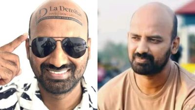 బట్టతలతో నెలకు రూ. 50 వేలు..కుర్రాళ్లు ఆలోచించుకోండి