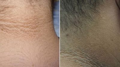 మెడ వెనుక నలుపు మురికి అనుకుంటున్నారా? పెద్ద అనారోగ్యానికి సంకేతం!