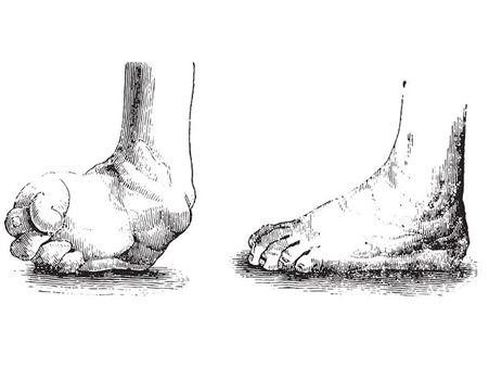 আঙুল বেঁকে যাওয়া