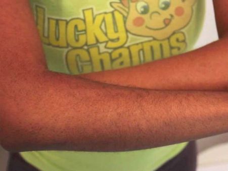 অবাঞ্ছিত লোম