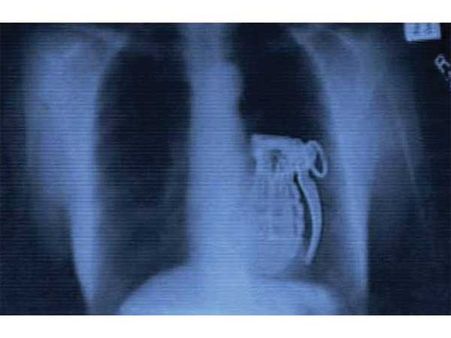 হাতবোমা